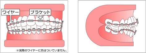 歯列矯正用のブラケットを正面から見た状態・側面から見た状態